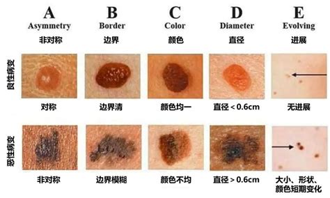 新的痣|为什么身上突然长出新痣？容易恶变吗？